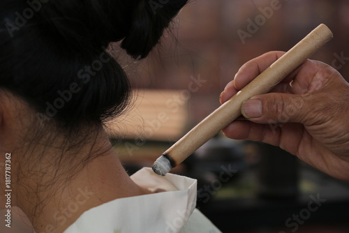 Canvas-taulu Chinese Moxibustion Therapy Treatment with Burning Moxa Stick on Patient Back Tr