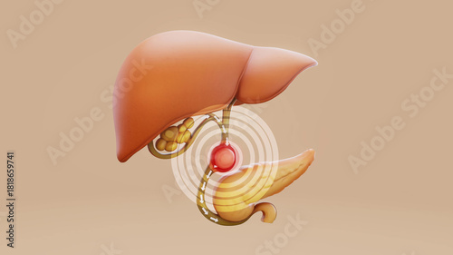 Conceptual 3D illustration of a gallbladder stone