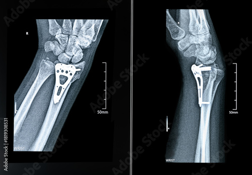 X-rayof hand surgical options for treating a distal radius fracture Inserting a purpose-built orthopaedic plate with open reduction and internal fixation frontal and lateral view