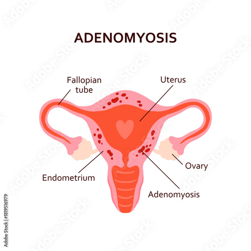 Adenomyosis Uterus Anatomy Vector Illustration. Labeled Diagram Showing Uterus, Fallopian Tubes, Ovaries, Endometrium and Adenomyotic Thickening. Flat Medical Graphic for Gynecology Education