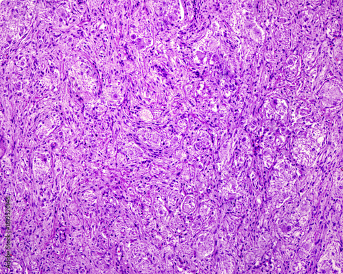 Superior cervical ganglion. Ganglioneuroma