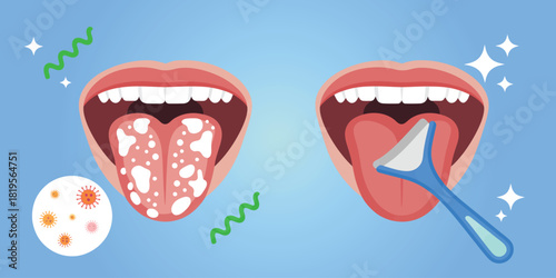 Bad Breath Removal Illustration With Tongue Cleaning, Halitosis Prevention, Plaque Reduction, Bacteria Control, and Modern Oral Hygiene Elements in a Clean Flat Health Care Vector Concept