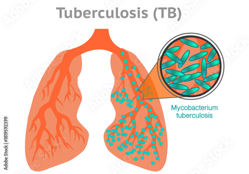 Tuberculosis is a bacterial infection that most commonly affects the lungs. Mycobacterium tuberculosis, microscopic section. Respiratory system diseases. 2d draw, Vector illustration