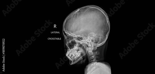 Bild auf Leinwand Skull x-ray showing cranial bones and facial skeleton