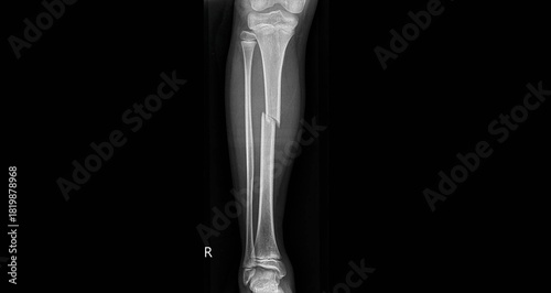 Tibia fracture x-ray showing broken bone with displacement. AP and lateral view radiographs for diagnostic examination of tibial shaft fracture and trauma injury