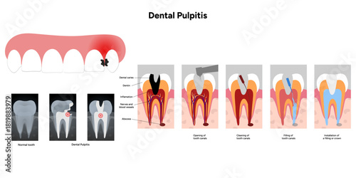 Hand-drawn dental infographic of dental pulpitis anatomy, root canal treatment, and X-ray view. Educational illustration for dentistry