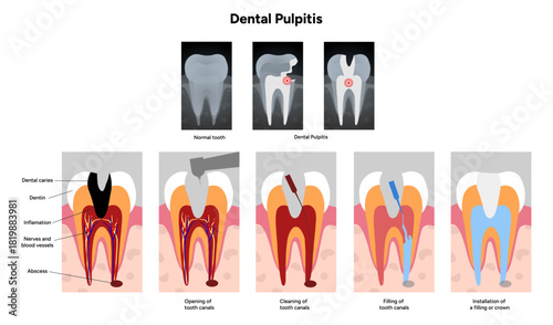 Hand-drawn dental infographic of dental pulpitis anatomy, root canal treatment, and X-ray view. Educational illustration for dentistry