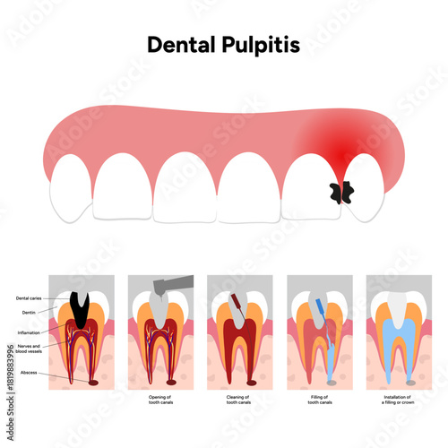 Hand-drawn dental infographic of pulpitis anatomy and root canal treatment, inflamed tooth pulp, root canals, cleaning, and filling process. Educational illustration for dental