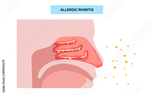 Allergic rhinitis poster