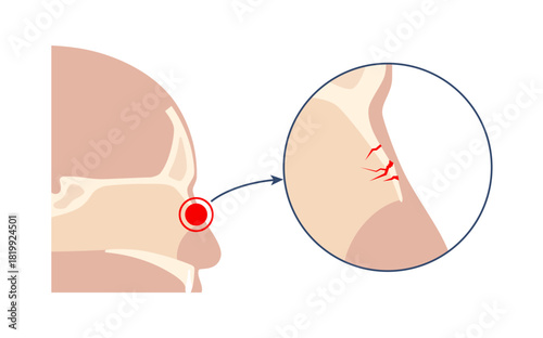Nasal fracture poster