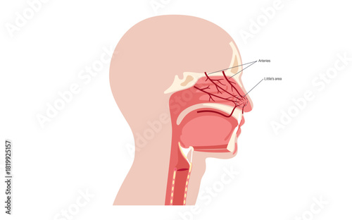Nosebleed medical poster