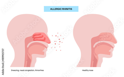 Allergic rhinitis poster