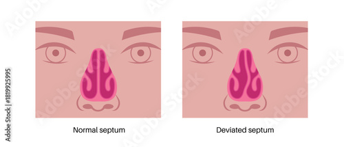 Deviated septum poster