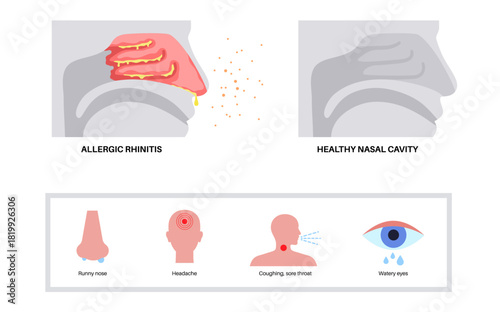 Allergic rhinitis poster