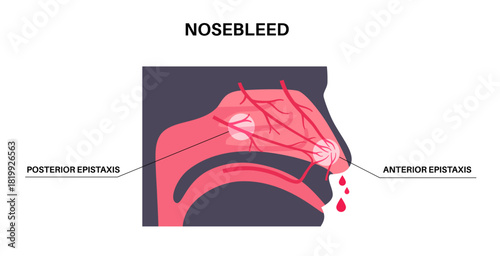Nosebleed medical poster