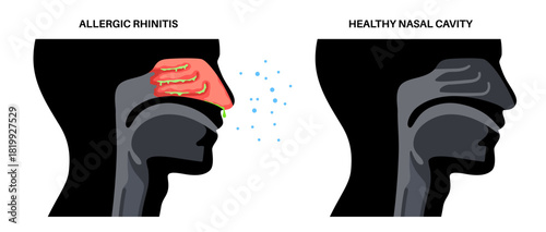 Allergic rhinitis poster