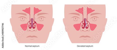 Deviated septum poster