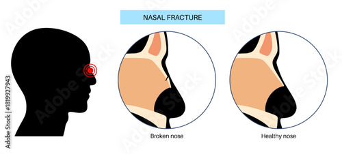 Nasal fracture poster
