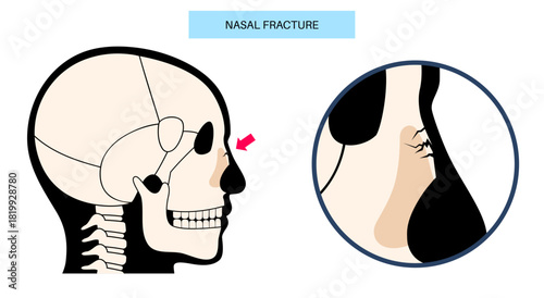 Nasal fracture poster