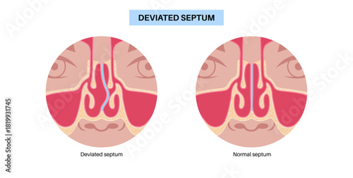 Deviated septum poster