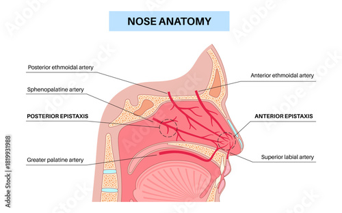 Nosebleed medical poster