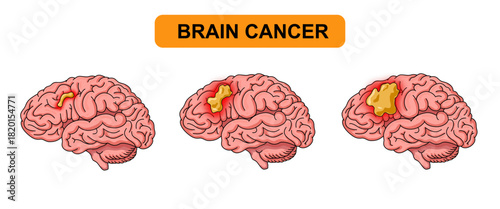  Brain tumor illustration. Human brain cancer, glioma, tumor in human brain tissue. Cancer cell structure. Vector illustration for medical, scientific, and educational purposes.