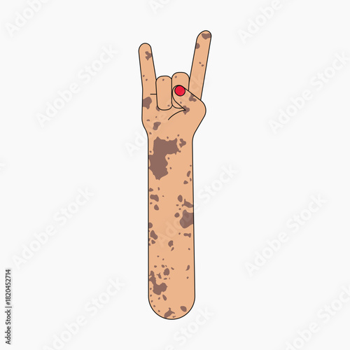 Vitiligo rock n' roll hand sign, flat collage element vector