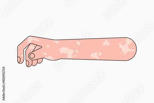 Vitiligo hand arm, gesture flat collage element vector