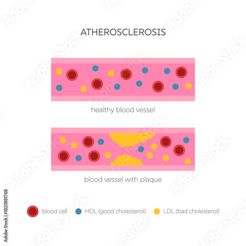 Atherosclerosis medical infographic. Flat diagram of cholesterol plaque buildup. Blood vessels with red cells, HDL and LDL lipoproteins. Hyperlipidemia cardiovascular disease vector illustration.