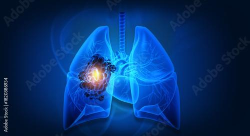 Human lungs cancer concept. Abnormal growth of tissue. 3d illustration