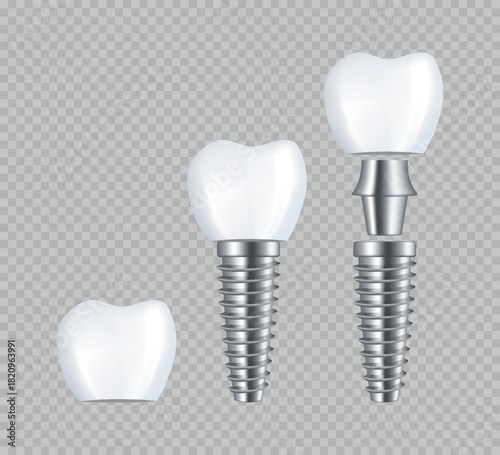 Dental implant. Realistic implant structure, graphic models of the crown. Screw prosthesis, Illustration of tooth implantation, orthodontic dental implantation.