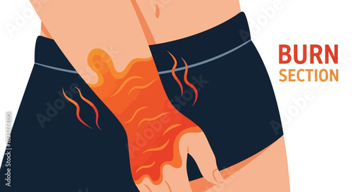 Persons arm with severe burn, showing flames and heat, with text burn section indicating medical area