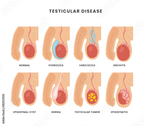 Illustration depicting various testicular diseases, including hydrocele, varicocele, and orchitis.