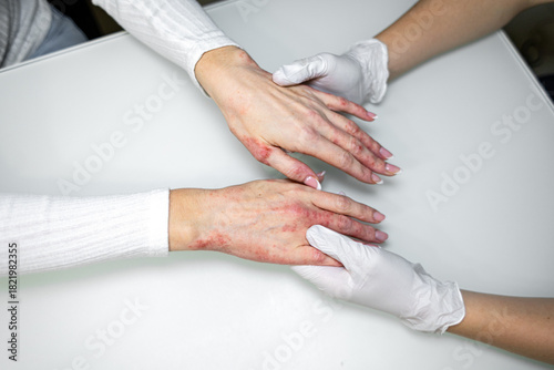 Treatment of eczema and psoriasis on hands with medical professional assisting in dermatology clinic