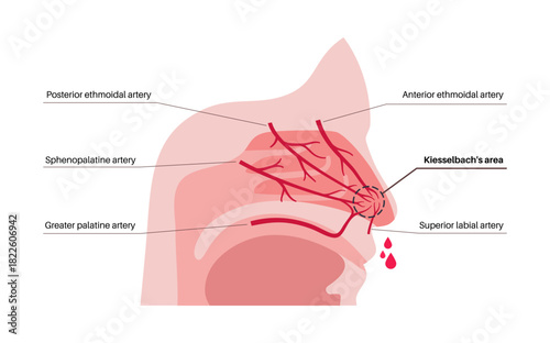 Nosebleed medical poster