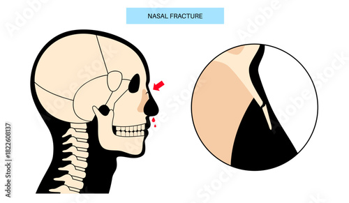 Nasal fracture poster