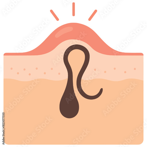 Ingrown Hair Skin Diagram showing an ingrown hair beneath the skin surface, ideal for skincare education, dermatology topics, and treatment guides