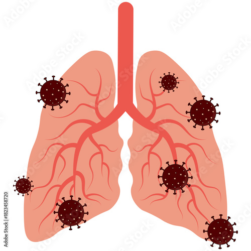 Pneumonia Illustration