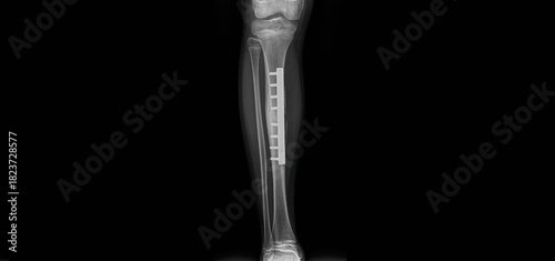 Postoperative tibia x-ray showing fracture fixation with plate and screws. AP and lateral view radiographs after ORIF surgery for tibial shaft fracture treatment