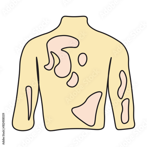 Tinea Versicolor on Human Back Skin