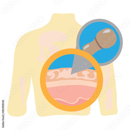 Tinea Versicolor on Human Back Skin