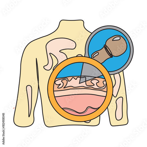 Tinea Versicolor on Human Back Skin