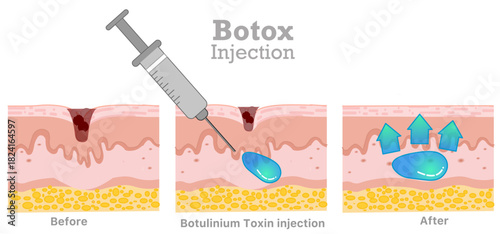 Dermal fillers, botox injection, botulinium toxin. Face, body serums,  Skin care, old dead cells. Before, after. Vector illustration	
