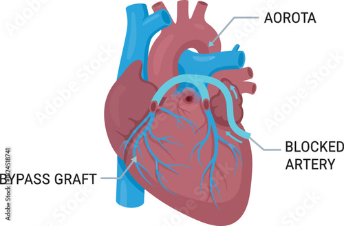 Medical illustration depicting a human heart with labeled components, including bypass graft and blocked artery.