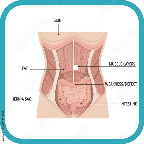 Medical illustration depicting the anatomy of the human abdomen, highlighting a hernia.