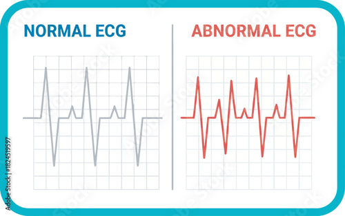 A medical illustration showing a comparison of normal and abnormal electrocardiogram readings.
