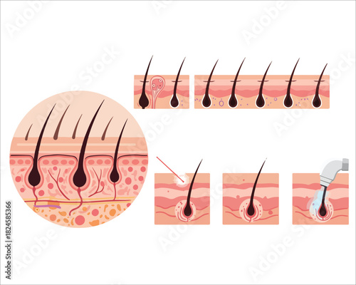 Diagram of hair follicle treatment options for hair loss and health