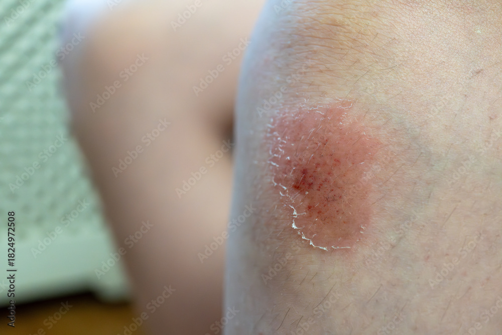 Fototapeta premium Skin rash on caucasian boy with dry texture and redness