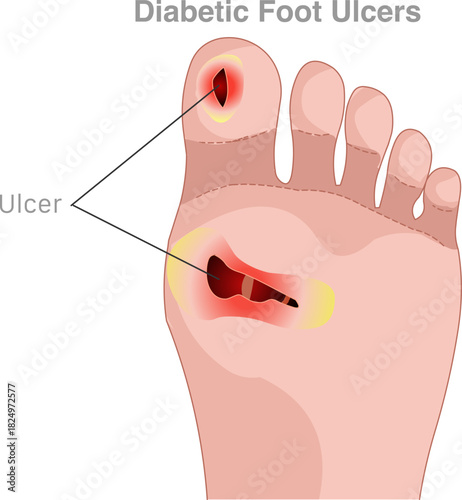  Diabetic foot ulcers, wound.  People with chronic conditions, such as diabetes, are particularly susceptible to foot ulcers. Poor blood circulation. Medical vector illustration