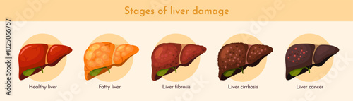 Stages of liver destruction. Medical infographic showing process of liver cell damage leading to fibrosis, cirrhosis, and cancer. Pathological process. Flat vector illustration